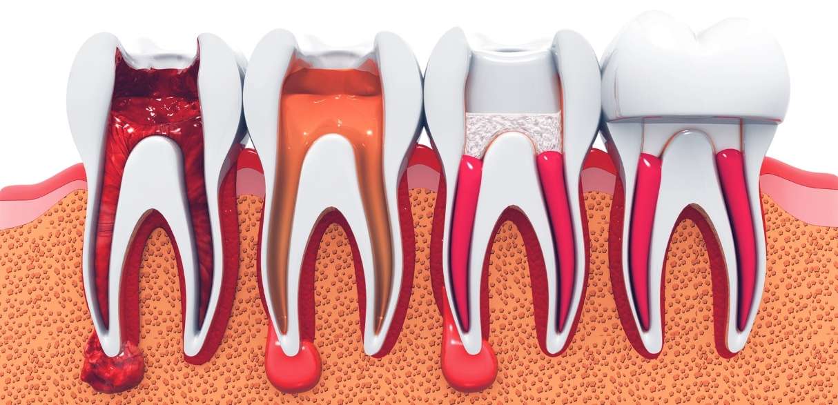 step-by-step guide on the root canal journey